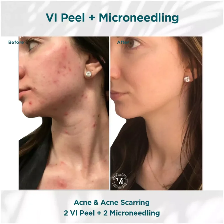 peel +microneedling in new york city