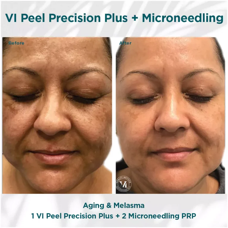 precision plus plus microneedling at Effortlessway Aesthetic