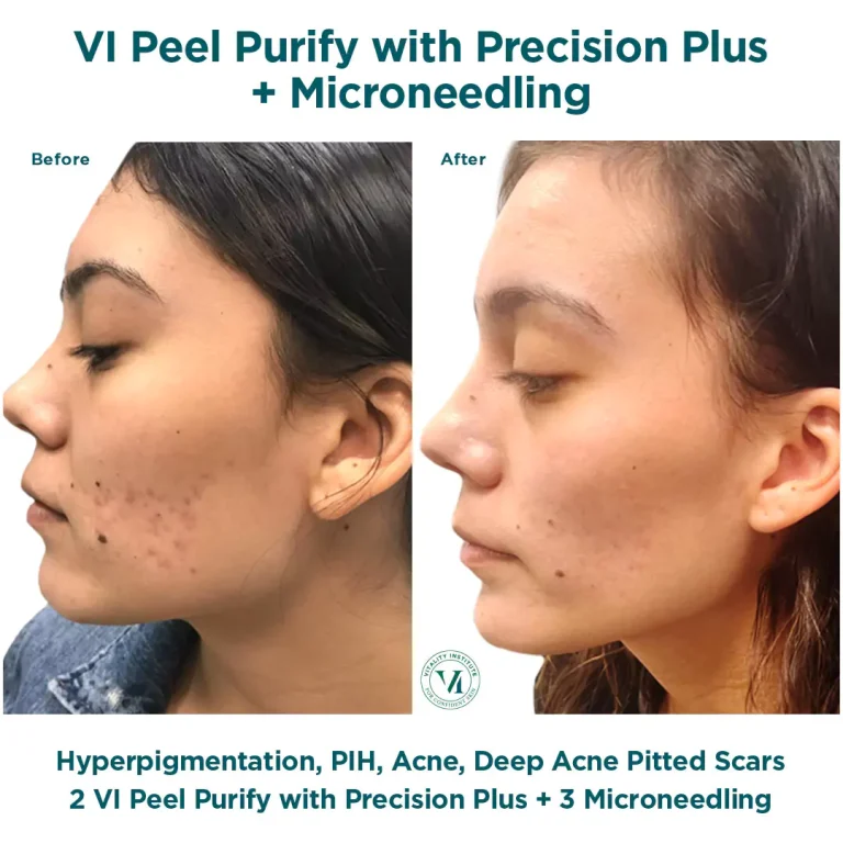 purify precision plus plus microneedling at Effortlessway Aesthetic in new york city