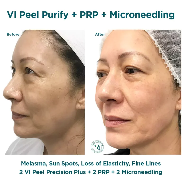 VI peel precision plus plus PRP plus microneedling at Effortlessway Aesthetic