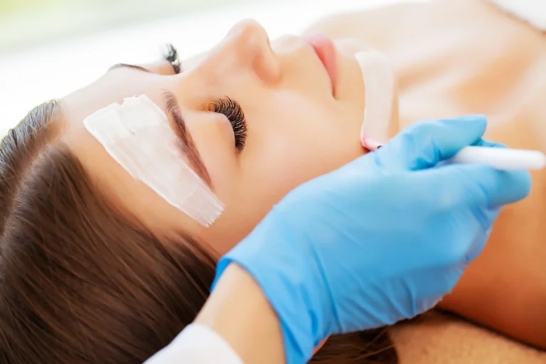 Chemical Peel services