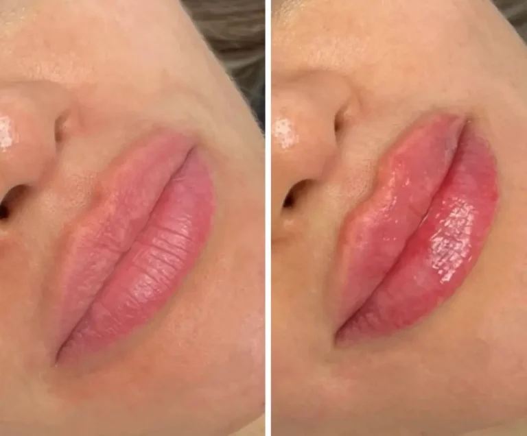 lip filler after and before in new york city