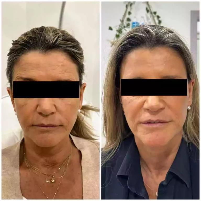 cheek filler and neurotoxin before and after need to mosaic eyes