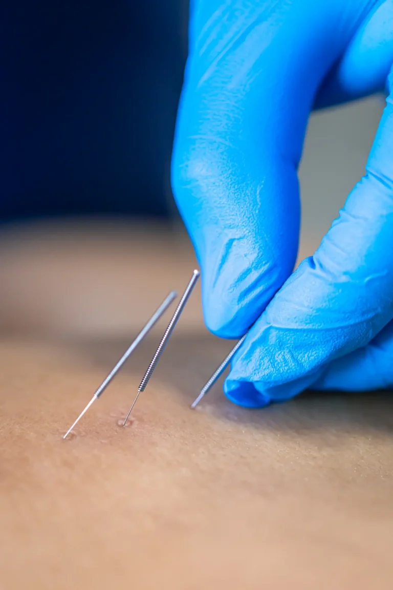 acupuncture for weight loss