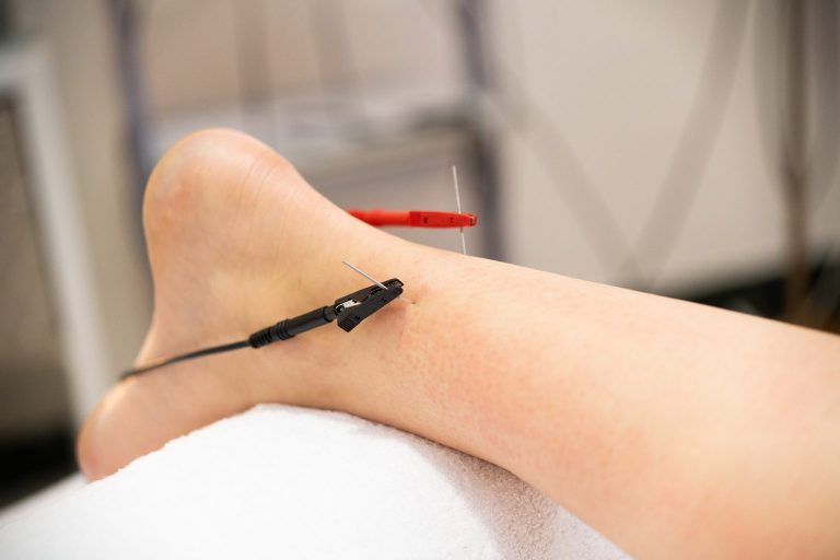 electro-acupuncture-dry-with-needle-connecting-mac