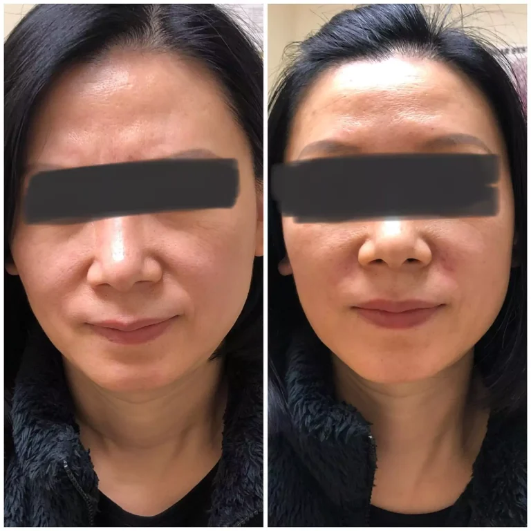 effortlessway hafiller reduces the appearance of nasolabialfolds