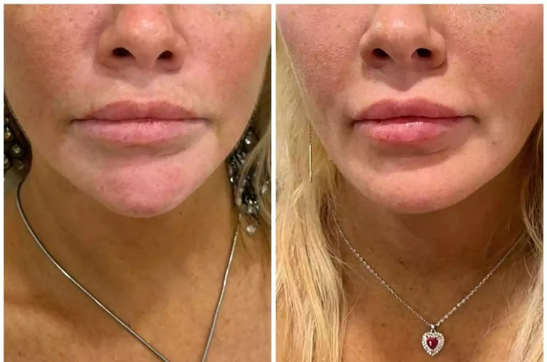 dermal lip filler before and after