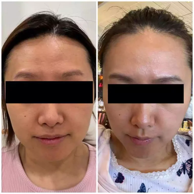 Before and after microneedling