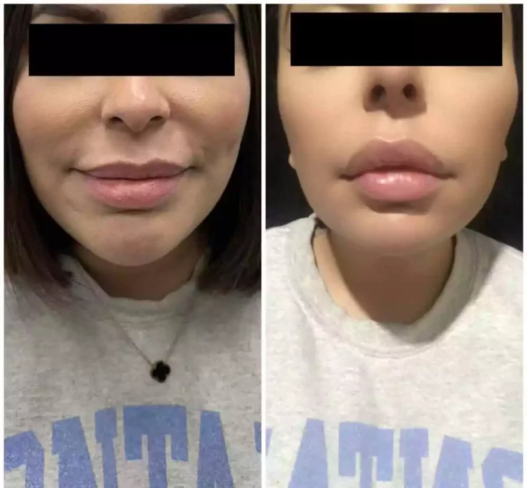 neurotoxin lip filler after and before resullt