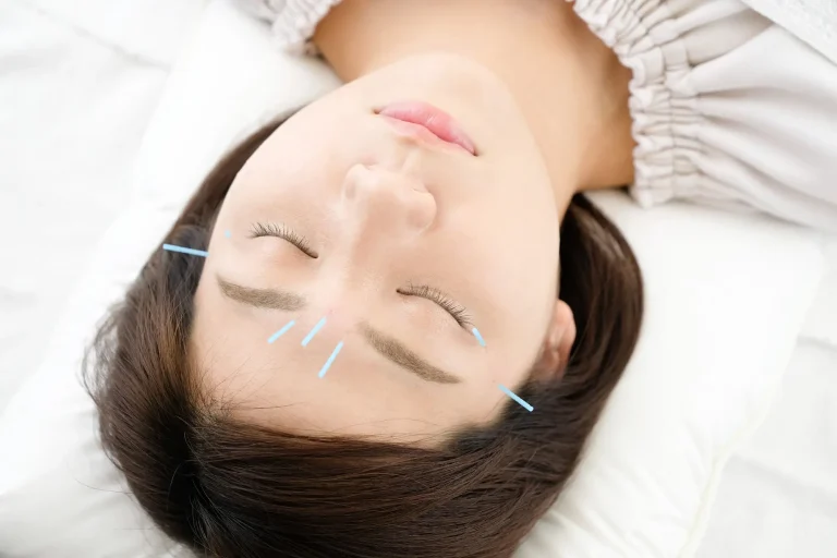 Pregnant-woman-getting-acupuncture-on-her-face at Effortlessway Aesthetic in new york city